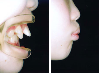 上顎前突＋叢生（乱杭歯）非抜歯症例3