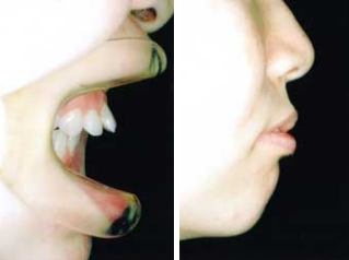 抜歯症例2