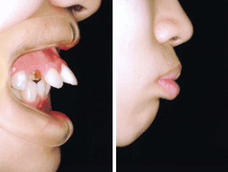 非抜歯症例1
